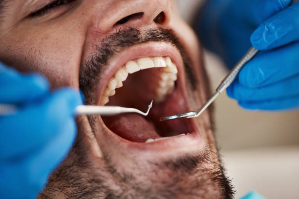 Best Urgent Care for Lost Fillings or Crowns in Wildomar, CA